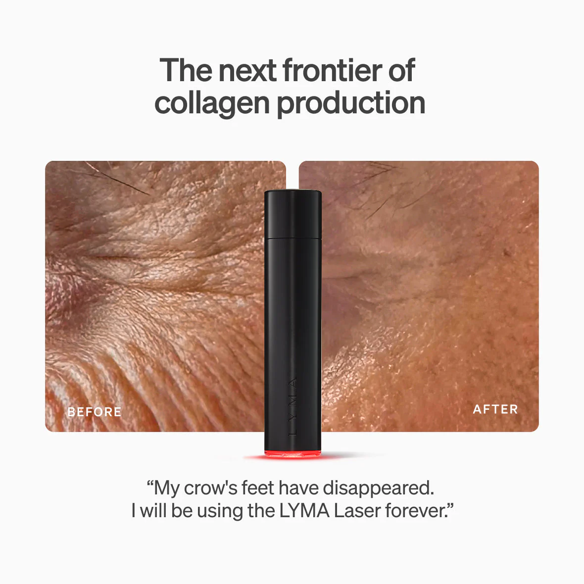 Lyma - LYMA Laser - Image 3