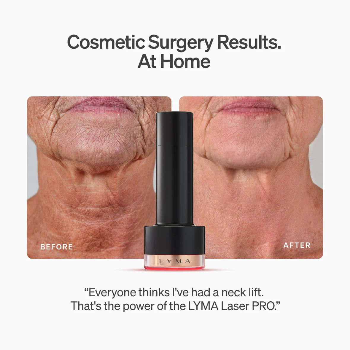 Lyma - LYMA Laser PRO - Image 3